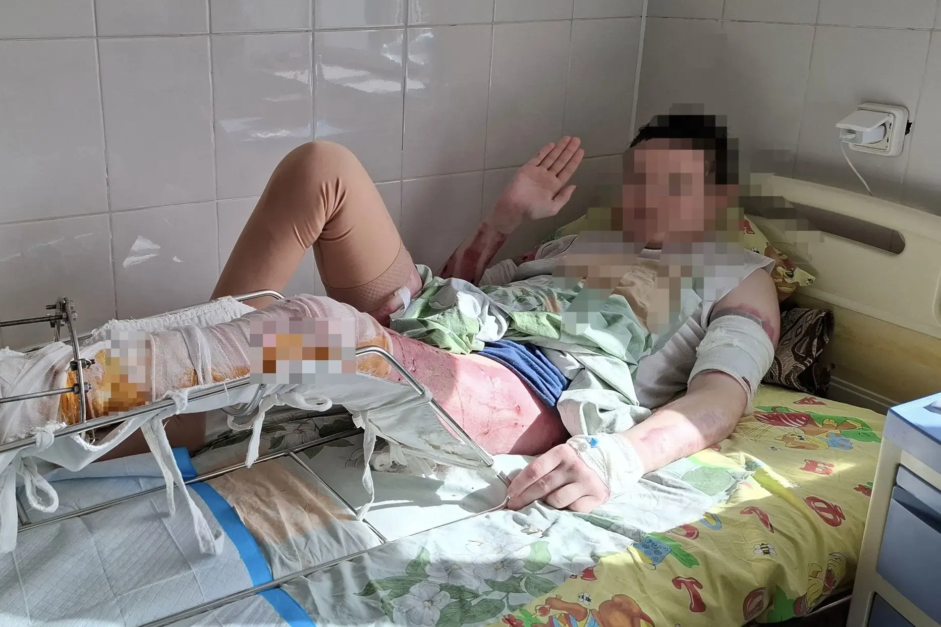 «Тело превратилось в одну сплошную рану…»: хирурги спасли подростку ноги после жуткой а...