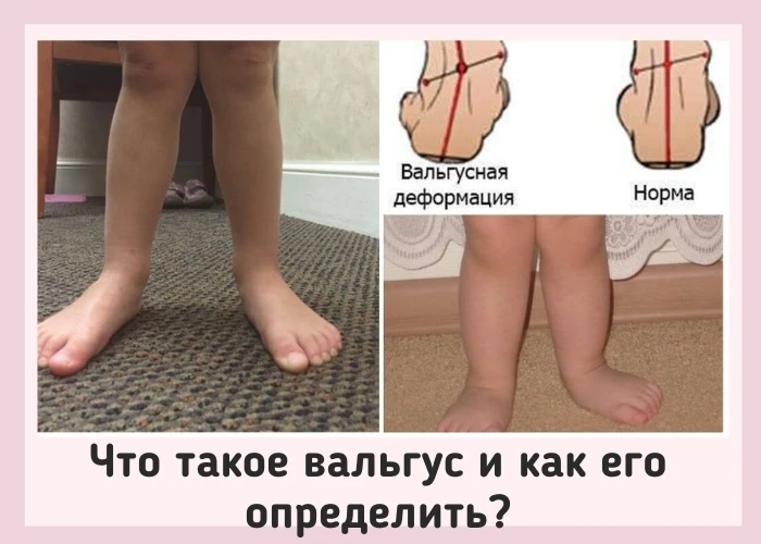 ЧТО ТАКОЕ ВАЛЬГУС И КАК ЕГО ОПРЕДЕЛИТЬ?