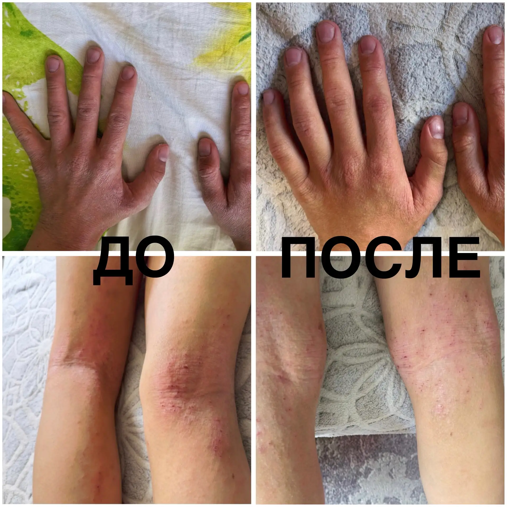 Дело о мальчике Егоре, у которого с 6 месяцев не проходила атопия, а в 11 лет кожа заго...