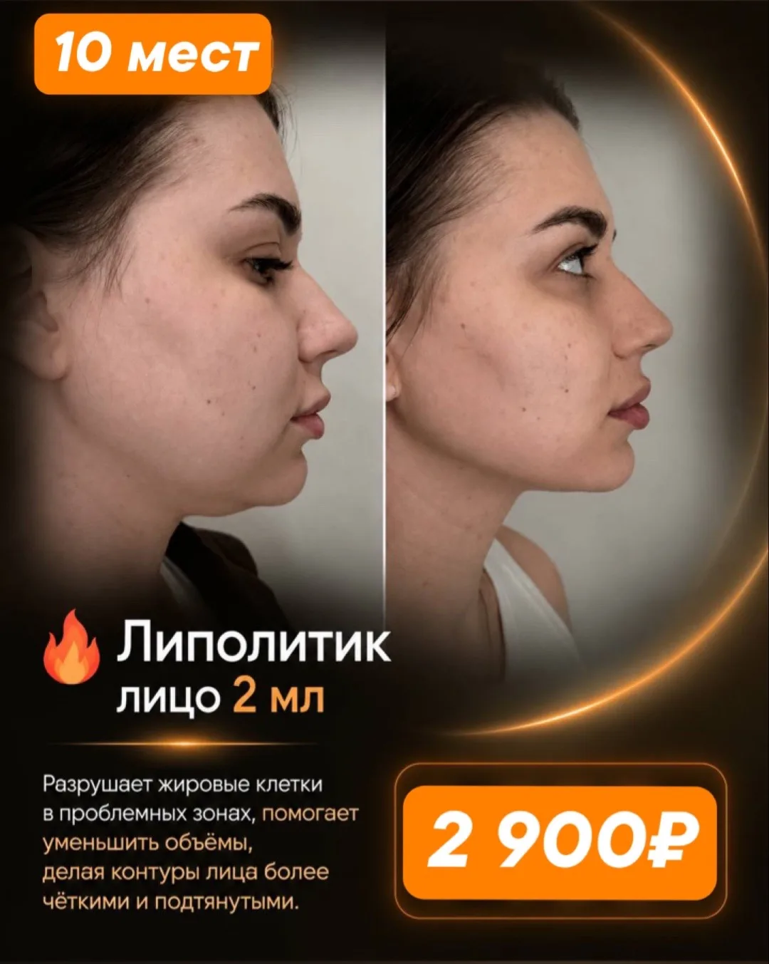 Желаете убрать второй подбородок, брали и живот и локальный жир без операции?