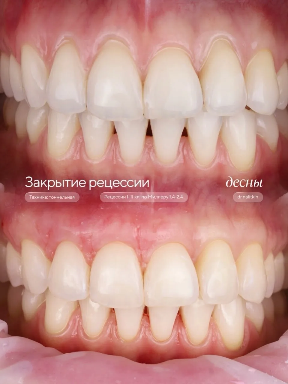 Закрытие рецессии десны: туннельная методика

Автор: Игорь Налиткин