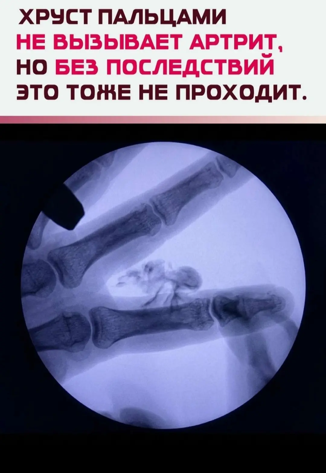 🙄Громкий щелчок при хрусте — это не трение костей, а резкое падение давления внутри сустава. В этот