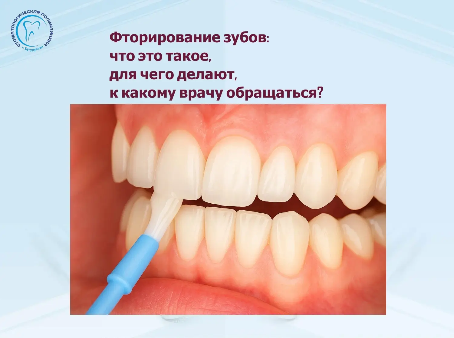 Фторирование зубов — это безболезненная стоматологическая процедура, направленная на ук...