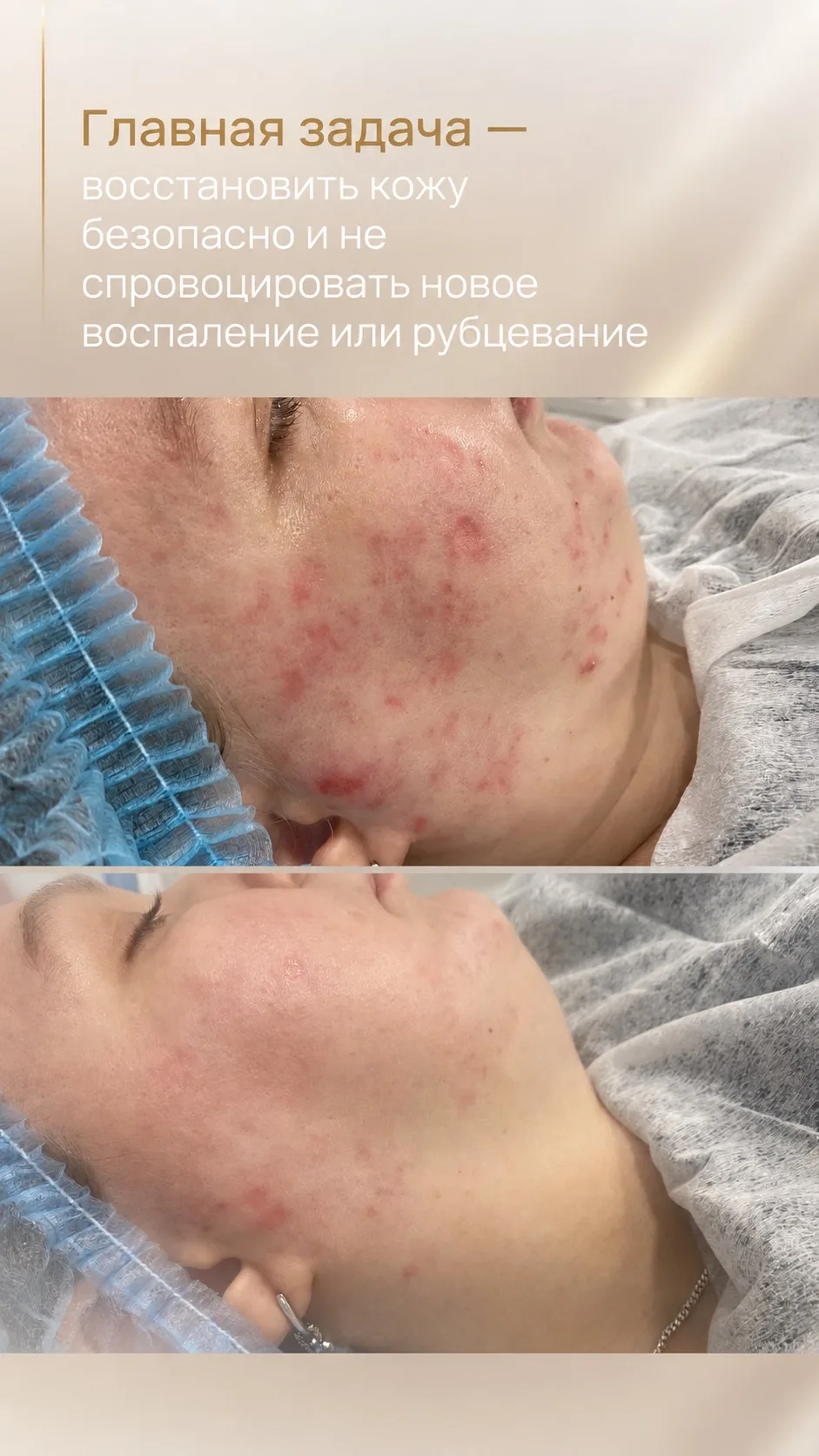Постакне: почему кожа продолжает напоминать о воспалении?