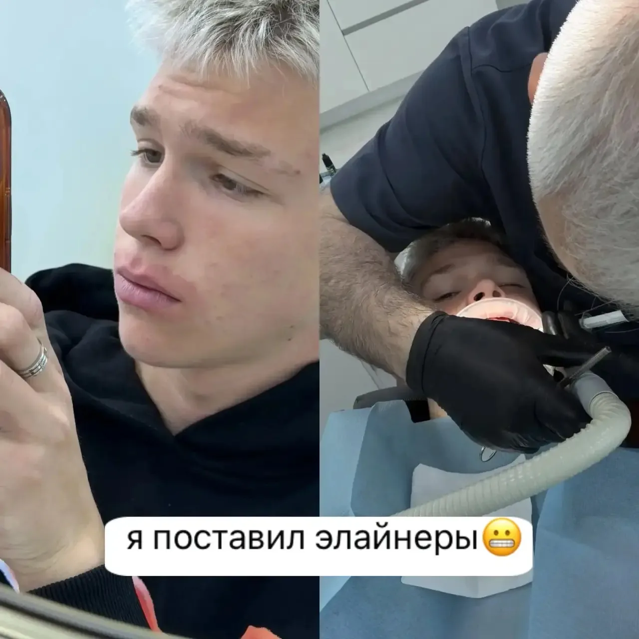 Никита поставил себе элайнеры.

🔥 — поздравляем