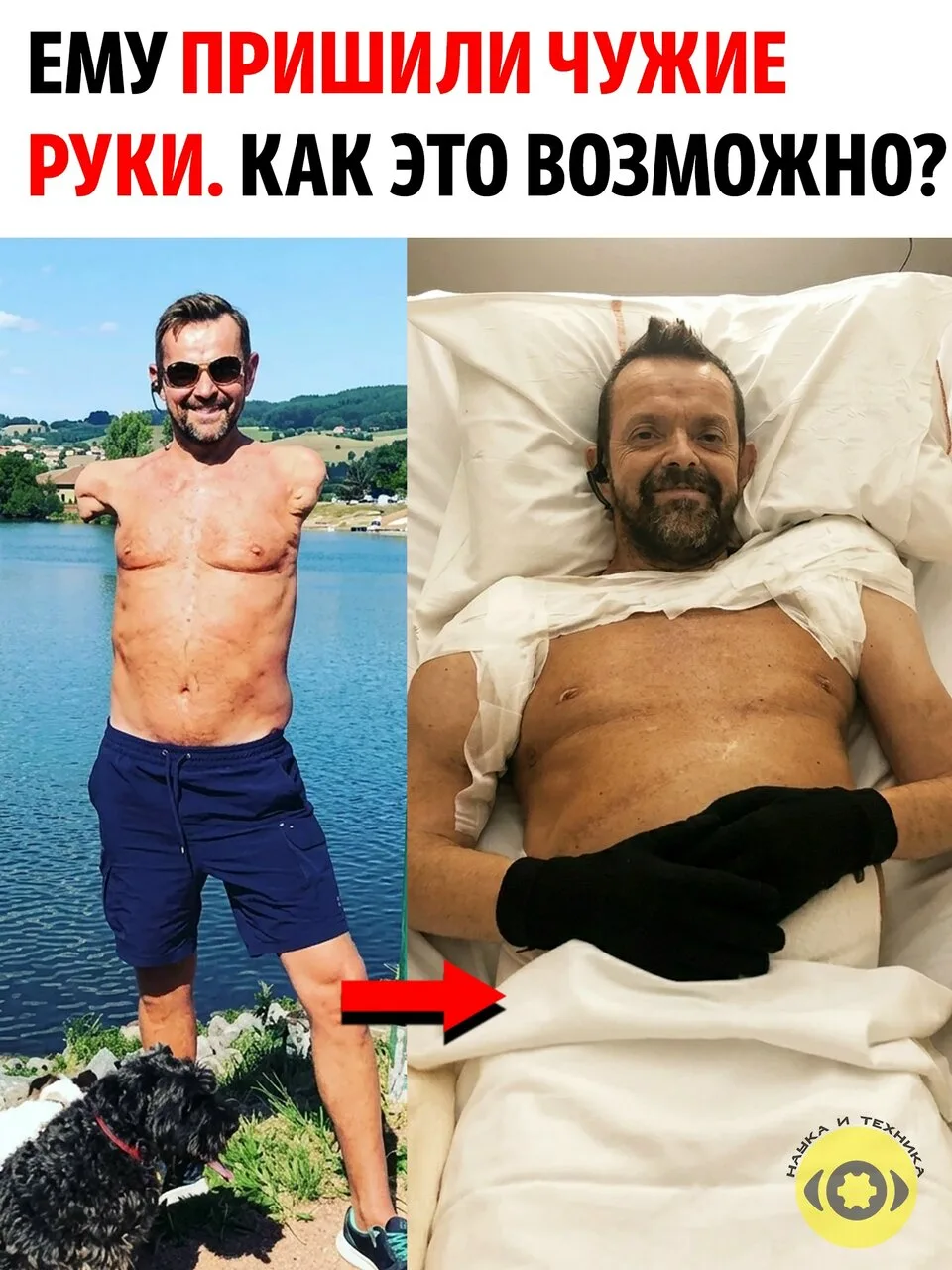 Исландец Феликс Гретарссон больше 20 лет жил без обеих рук.