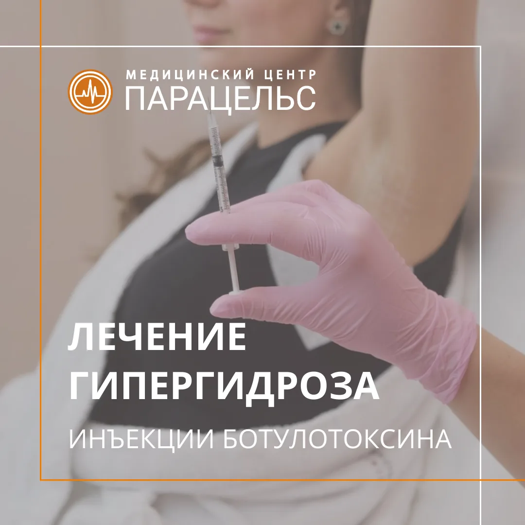 💦 ЛЕЧЕНИЕ ГИПЕРГИДРОЗА: забудьте о потливости с помощью ботулинотерапии.