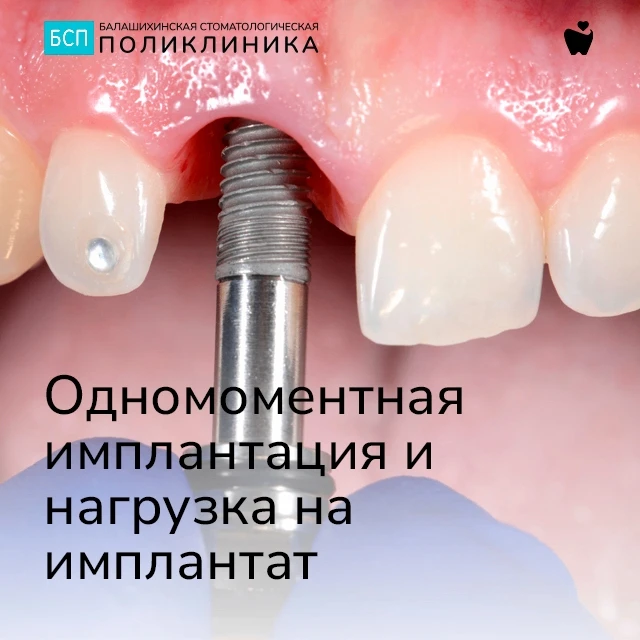 🦷🔩 Одномоментная имплантация и нагрузка на имплантат