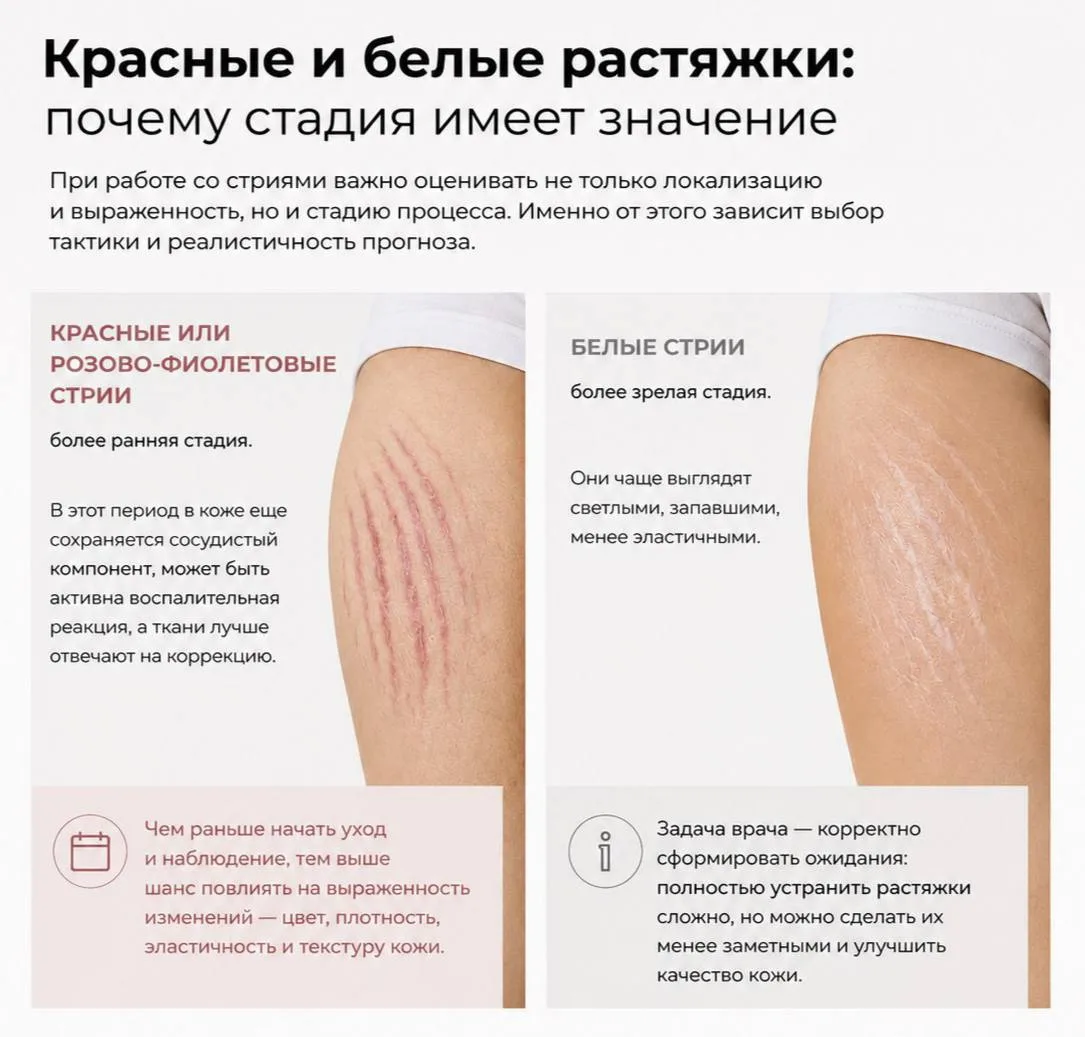 Растяжки