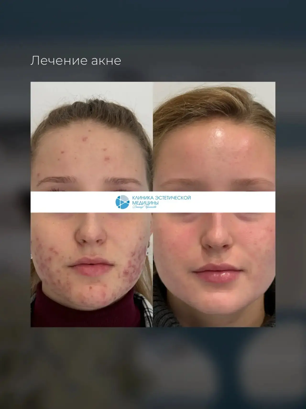 Акне — это не "просто прыщи" или "возрастное"