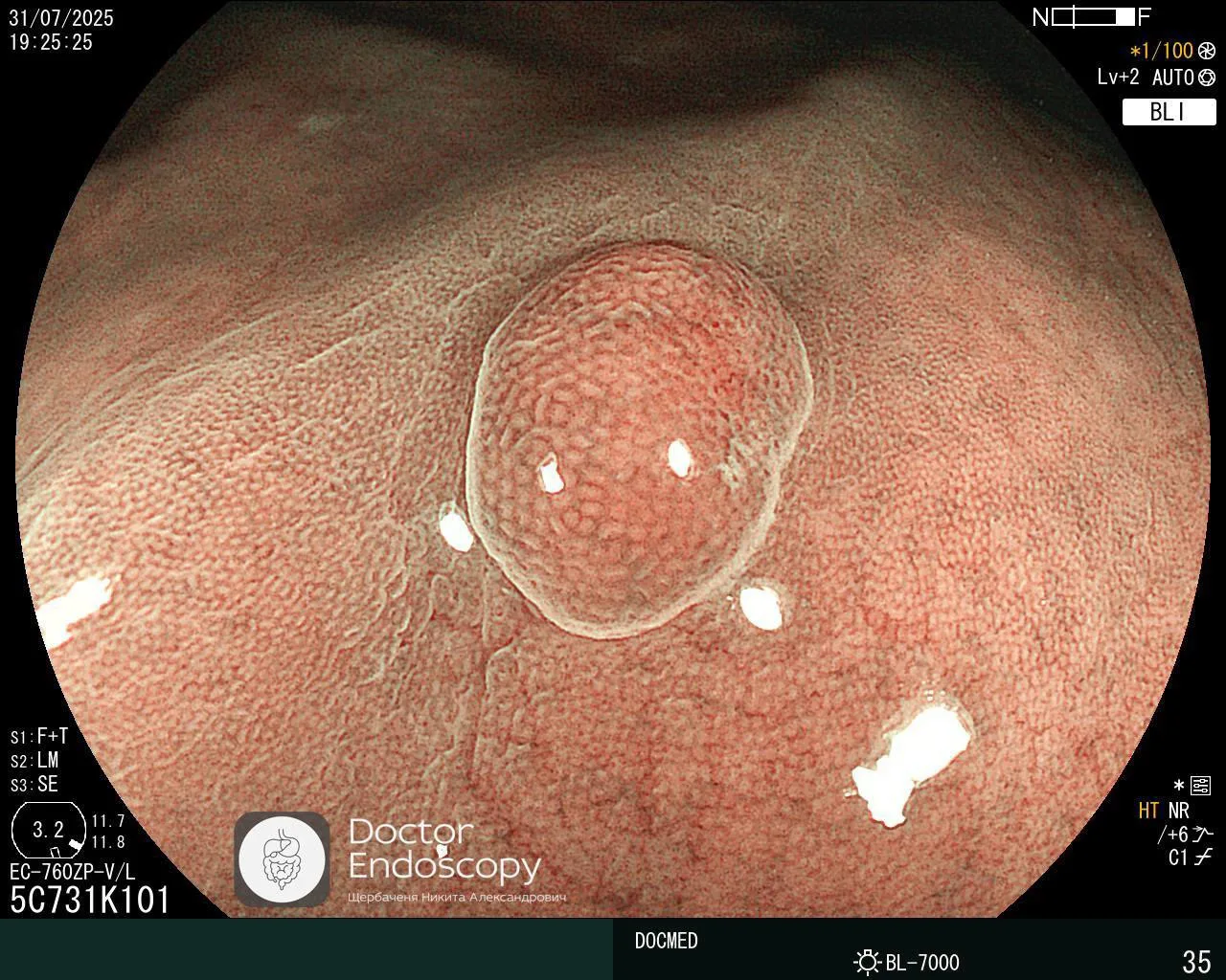 🌐 Fundic gland polyps (FGPs, полипы фундальных желёз) являются наиболее часто встречаю...