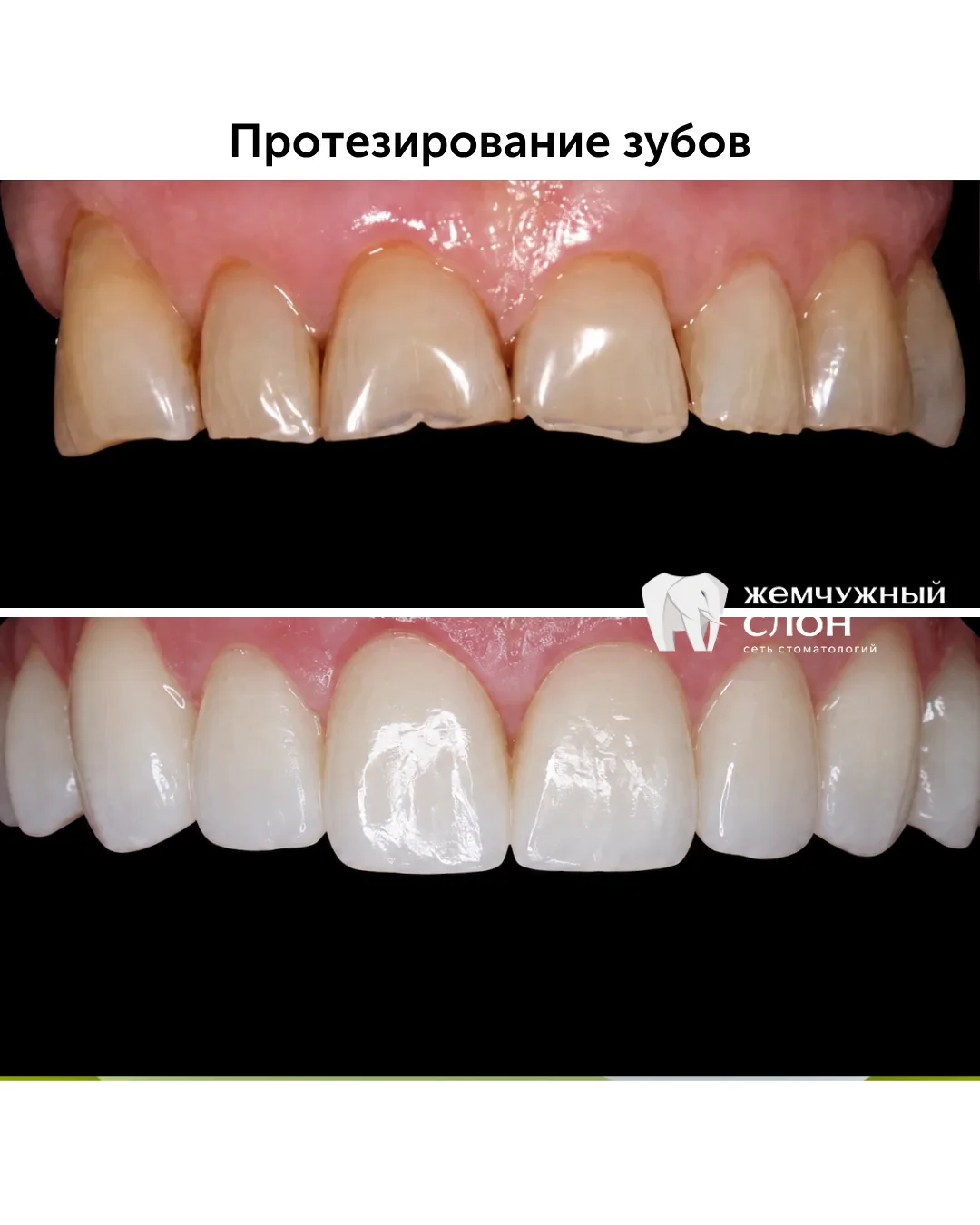 Выполнили профгигиену, затем пролечили то, что требовало лечения, далее - импланты. А в...