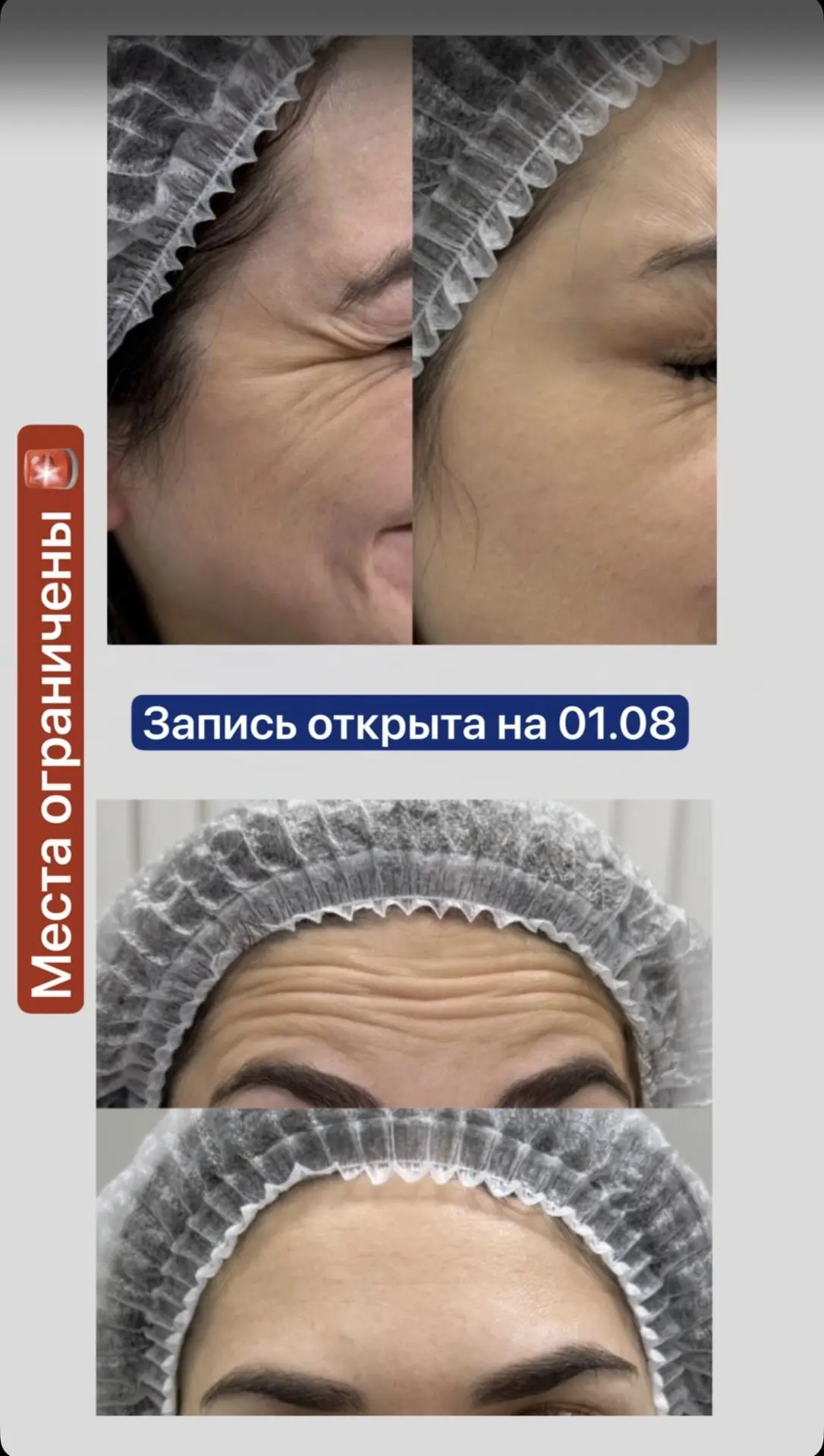 ✨ Поверните время вспять — подарите своей коже молодость! ✨

Морщины вокруг глаз, складки на лбу и п