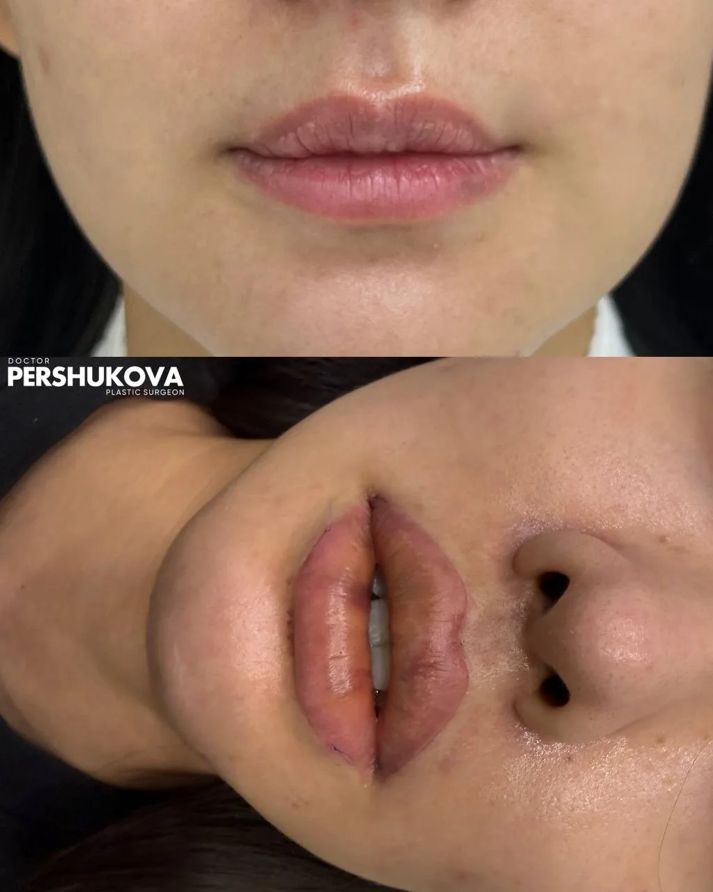 6-е сутки после пластики верхней и нижней губы  КЕССЕЛЬРИНГ