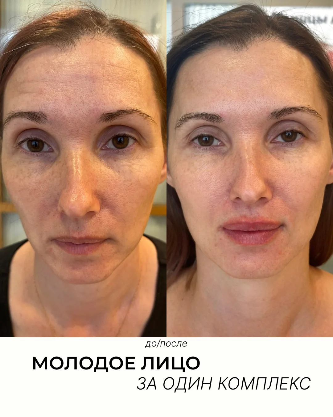 Молодое, отдохнувшее лицо - за один комплекс🤍