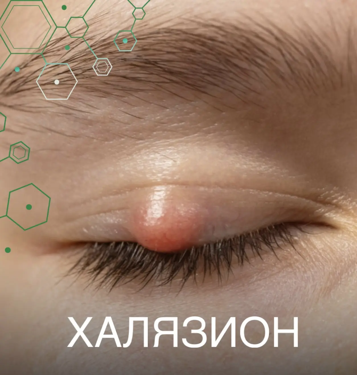 Халязион: что это и как с ним справиться? 👁️