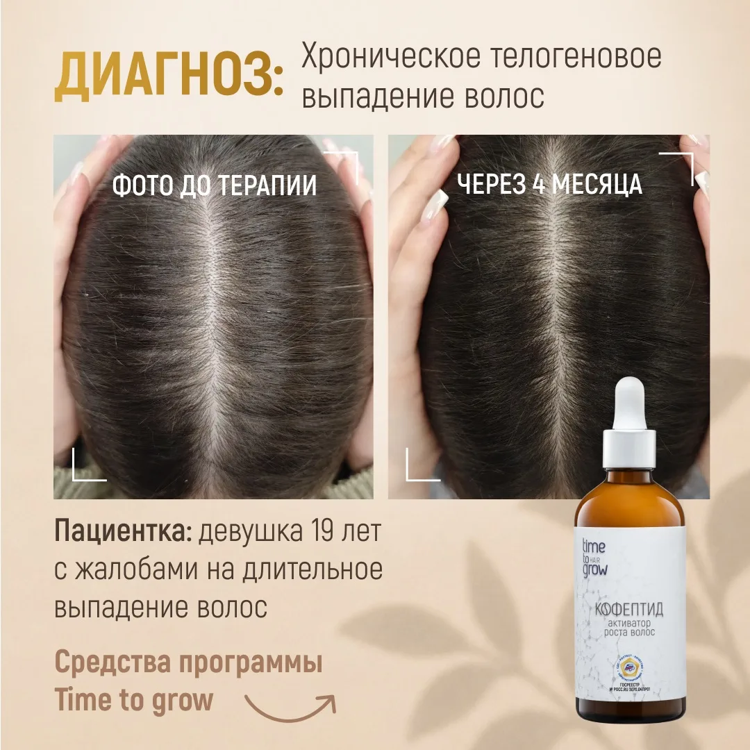 Клинический случай  из практики врача трихолога, косметолога, дерматовенеролога, Члена Национального