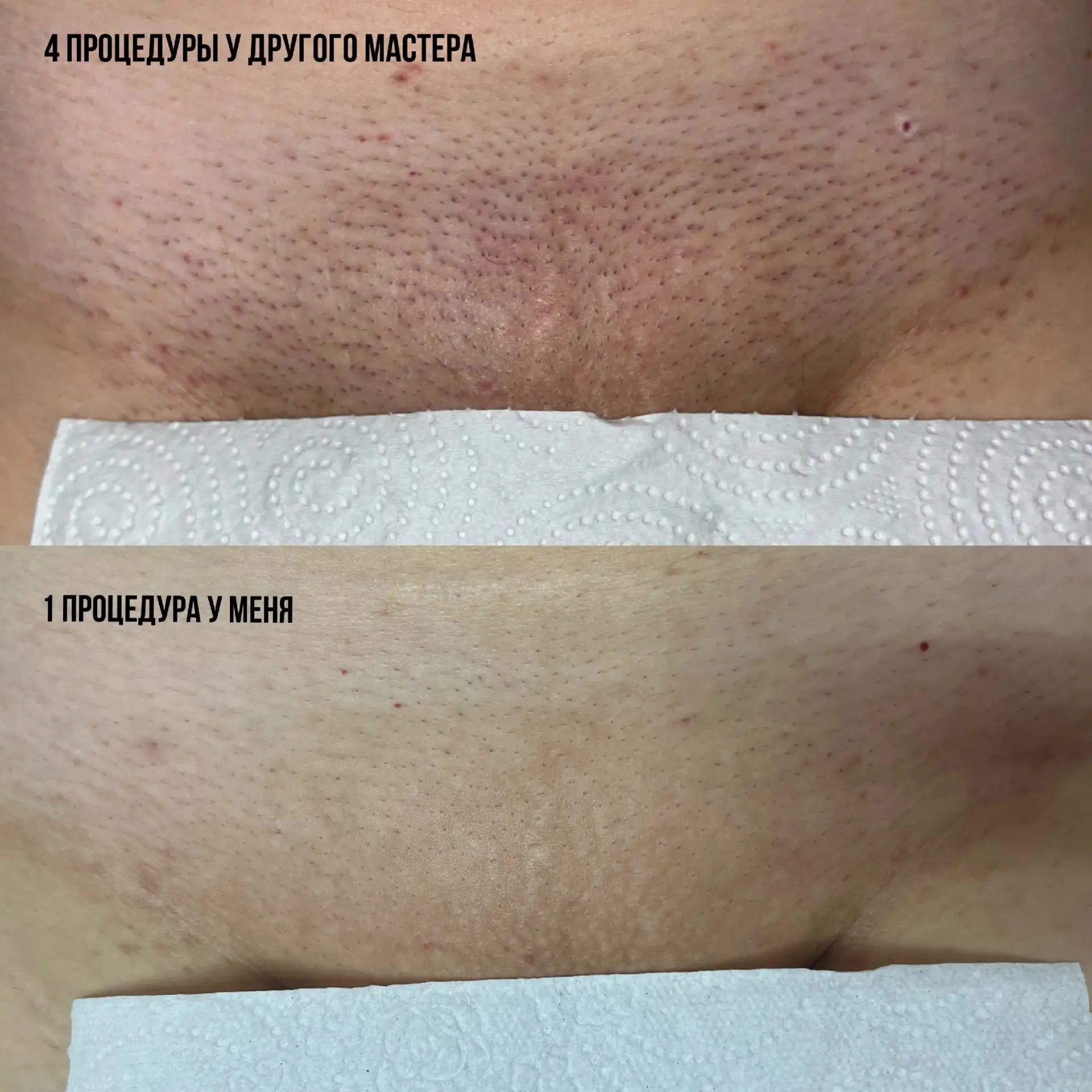 Главная ошибка, которая мешает получить результат от лазерной эпиляции