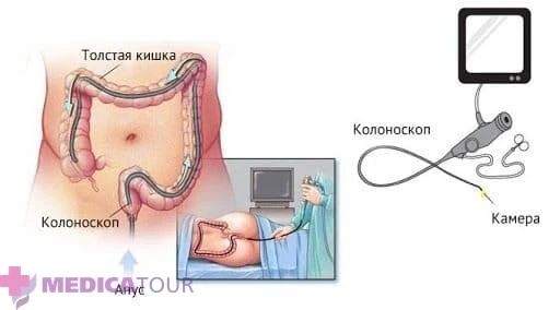 О колоноскопии: всё, что нужно знать о диагностике и профилактике
👨‍⚕️

Колоноскопия представляет с