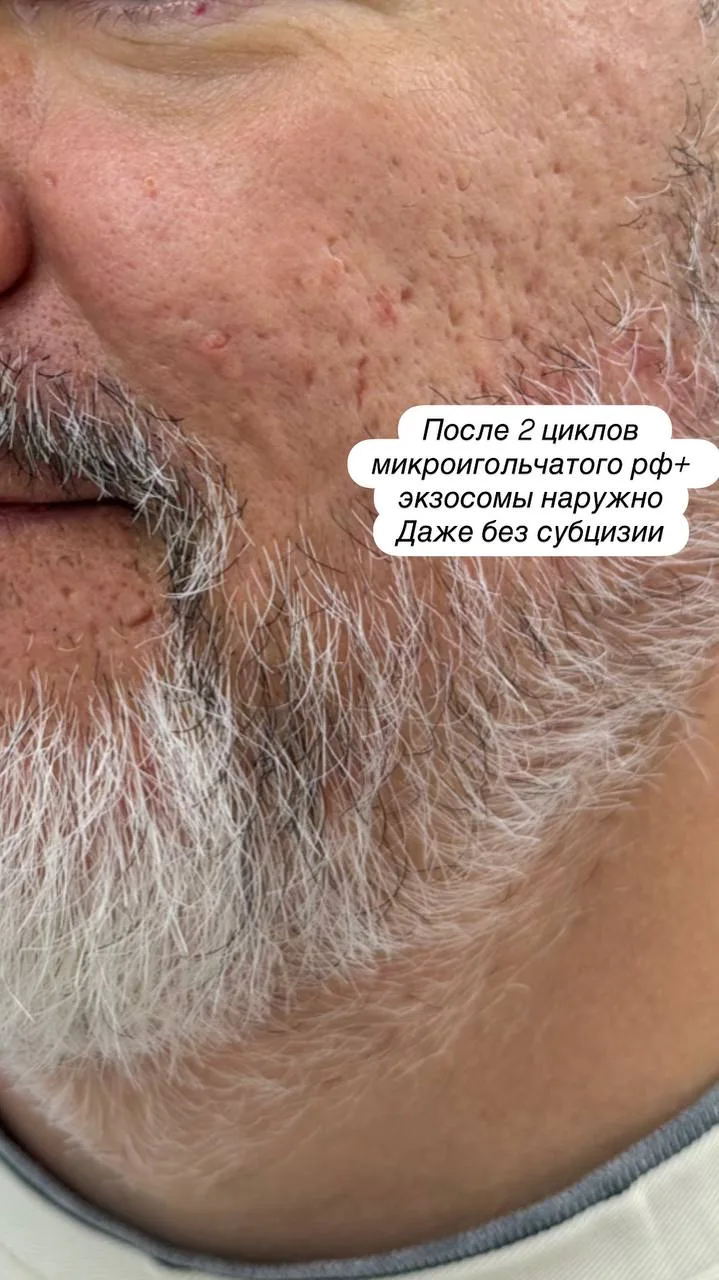 Одна из самых эффективных методик по восстановлению кожи- это микроигольчатый РФлифтинг.