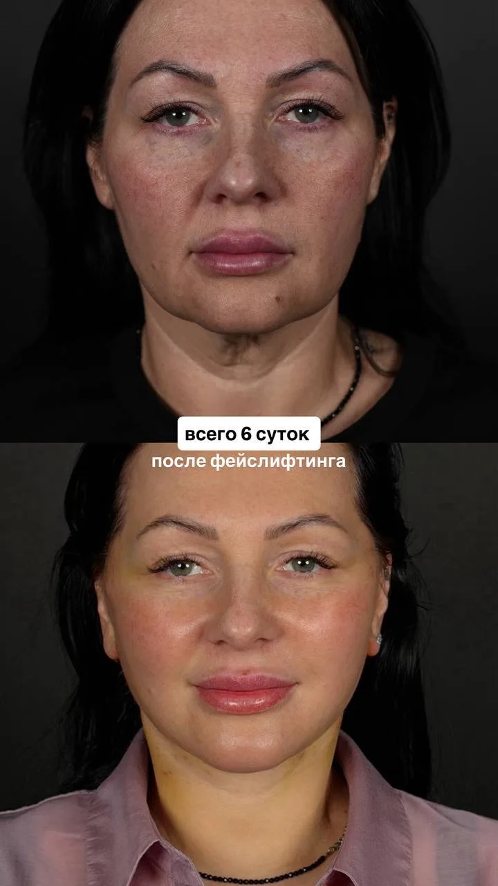 Фейслифтинг. Ранний этап реабилитации 💚