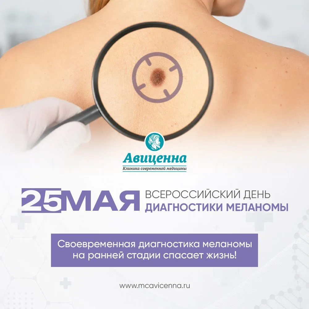 25 мая всероссийский «День диагностики меланомы»🩵