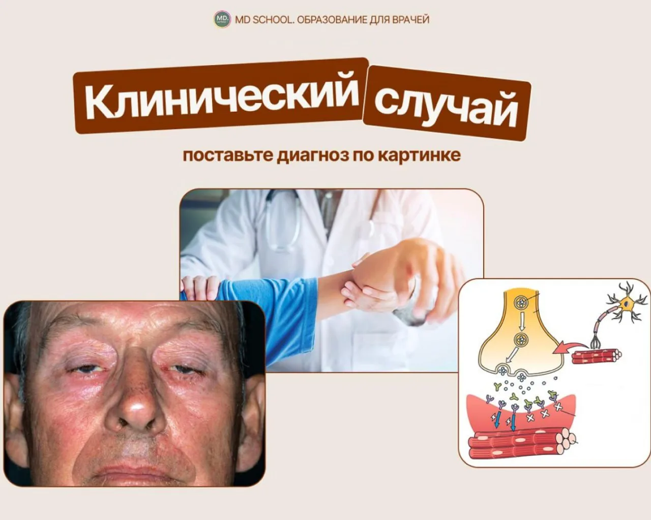 Врачи, сможете поставить диагноз по картинке? ↗️

Какой наиболее вероятный диагноз? 

👍 — Миастения