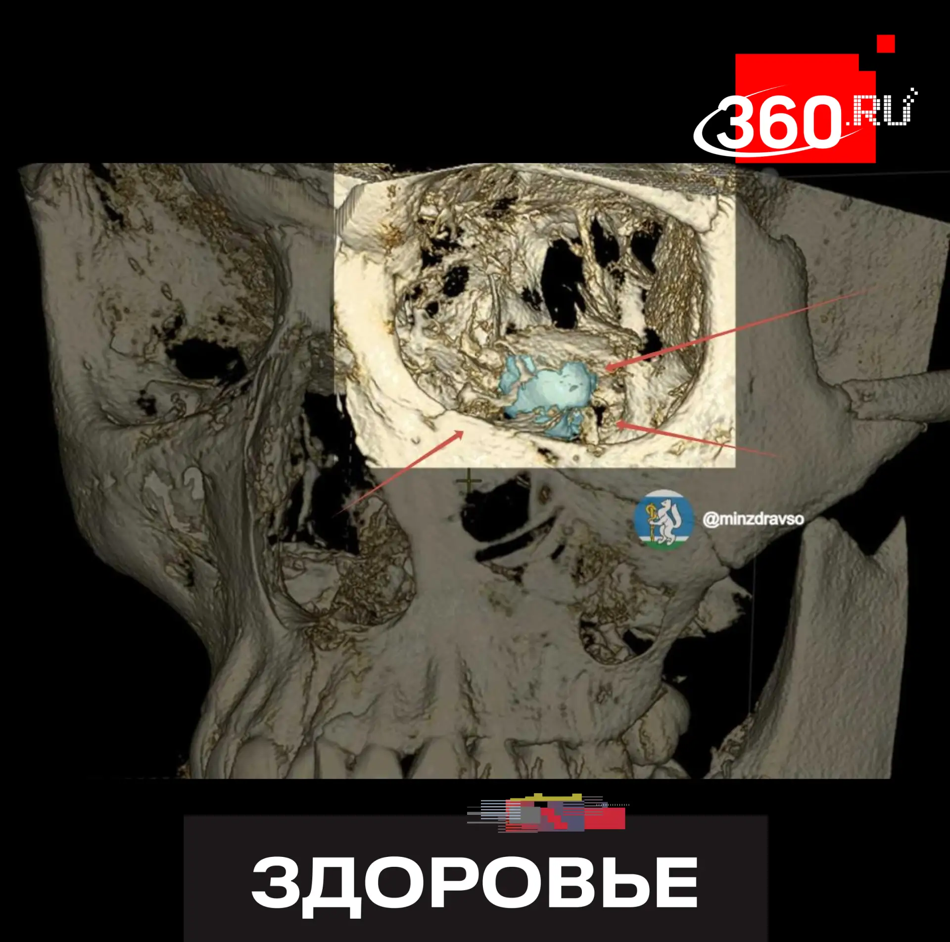 Зуб мудрости удалили из носа у 14-летней екатеринбурженки.