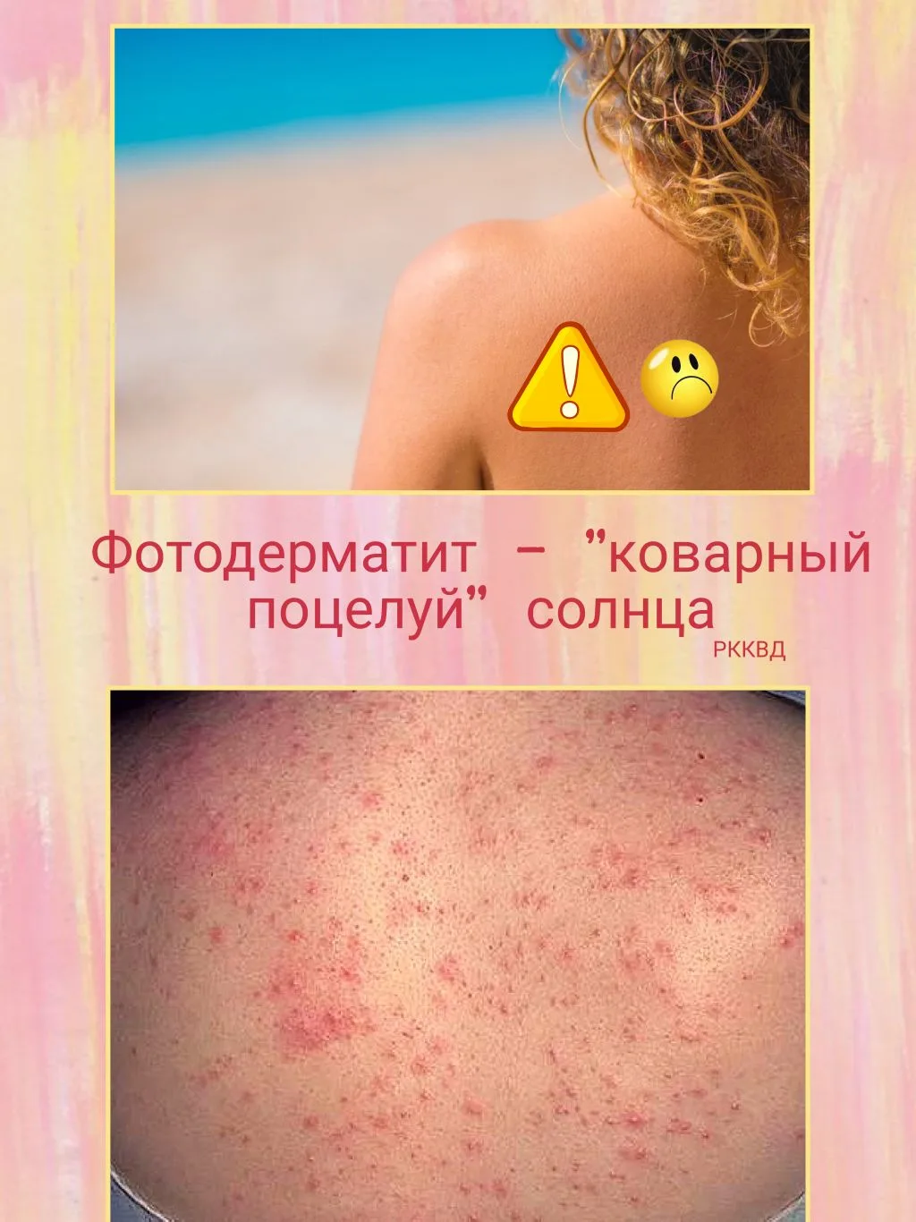 Фотодерматит - специфическая реакция кожи, которая может появиться даже после недолгого пребывания н