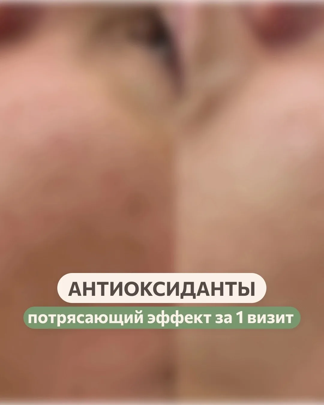 Вам очень нужны антиоксиданты 🙏🏻

Это то, что спасёт кожу от солнца, поможет профилактировать гипе