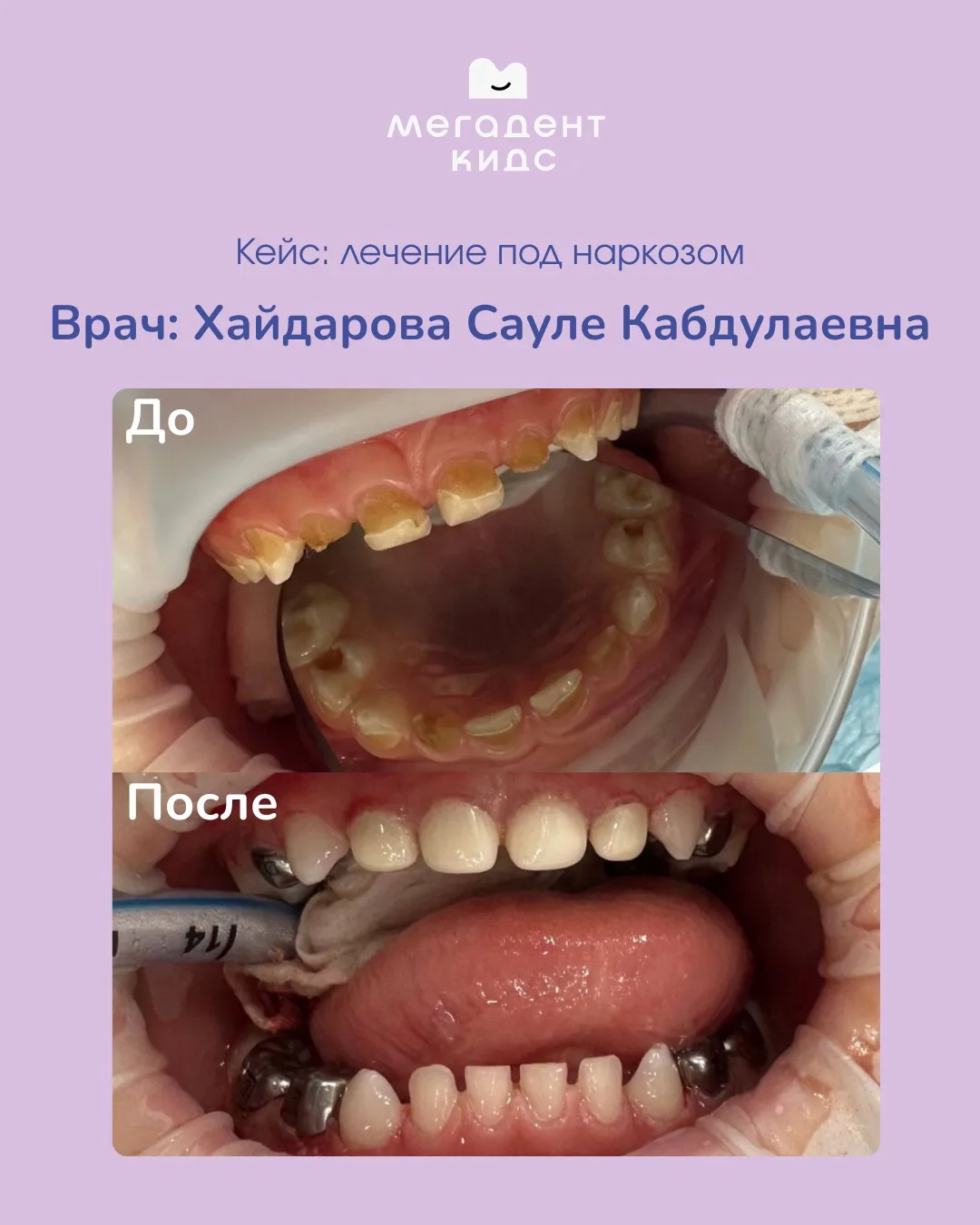 Лечение кариеса молочных зубов.