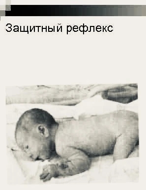 Своевременное угасание примитивных рефлексов критически важно для нормального моторного развития реб