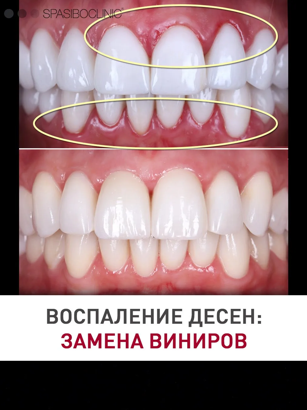 Воспаление десны через несколько лет после установки виниров может случиться, если цеме...