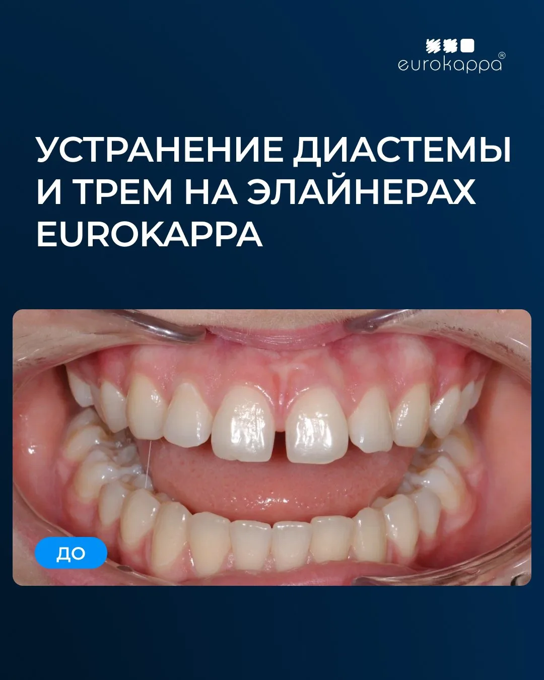 🦷 Кейс: Устранение диастемы и трем на элайнерах EUROKAPPA (сложность 2)