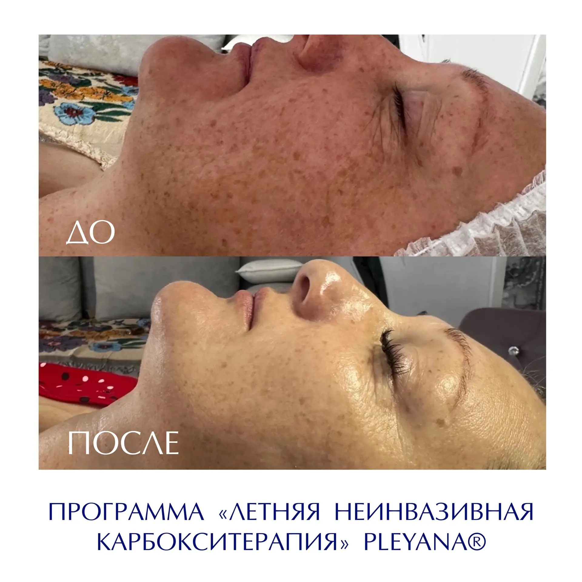 До/после 💙

ПРОГРАММА «Летняя неинвазивная карбокситерапия» PLEYANA

Автор работы: Машало Оксана, к