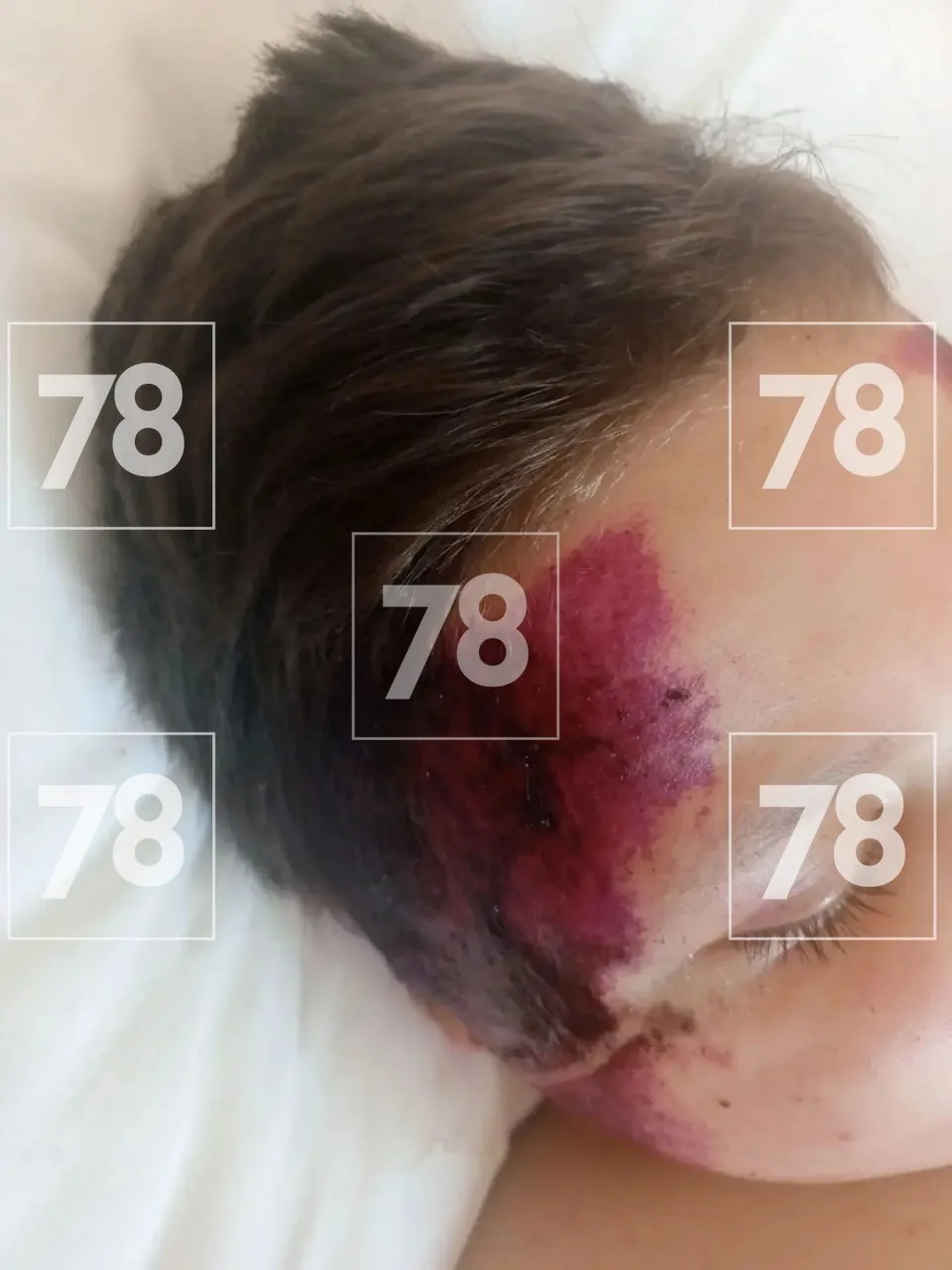 🚑 Сбитый на детской площадке мальчик пришёл в себя после операции

9-летний ребёнок, пострадавший н