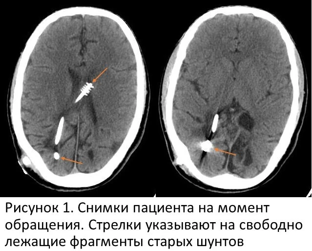 В НМИЦ нейрохирургии им. акад. Н.Н. Бурденко спасли пациента, перенесшего 48 операций н...