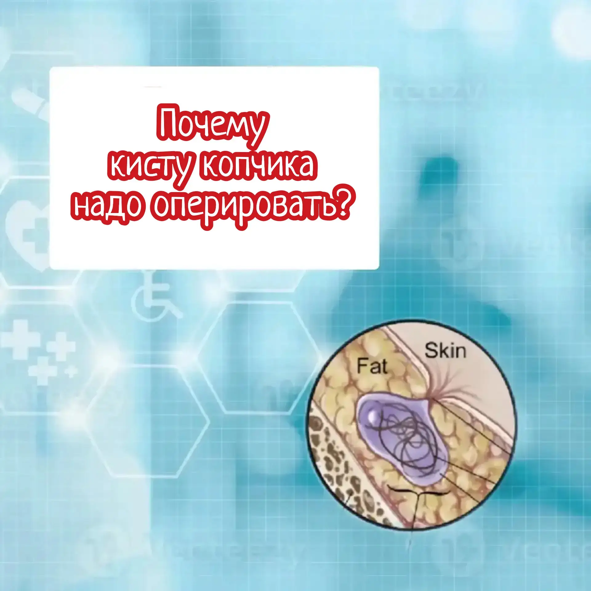 Почему кисту копчика надо оперировать?