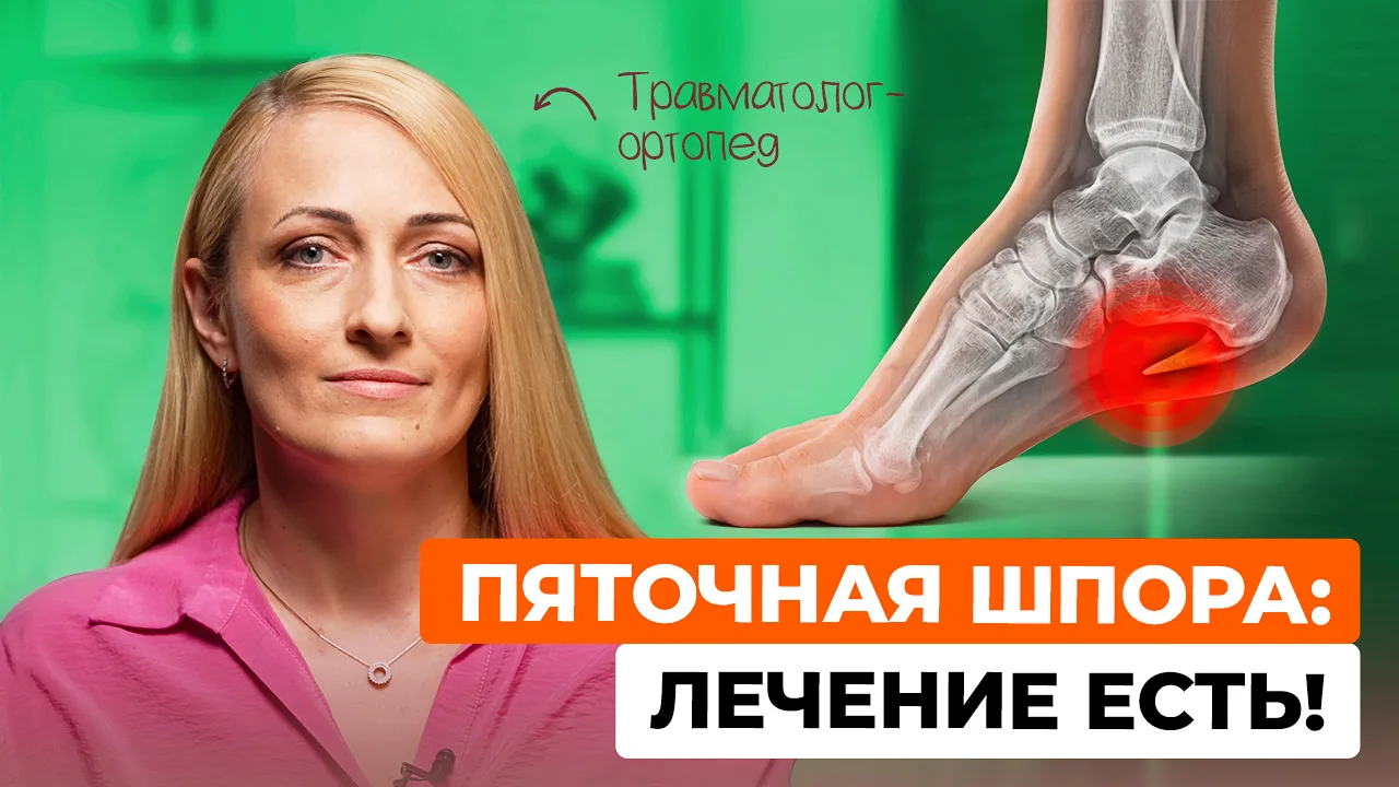 Пяточная шпора: почему болит пятка и что с этим делать?