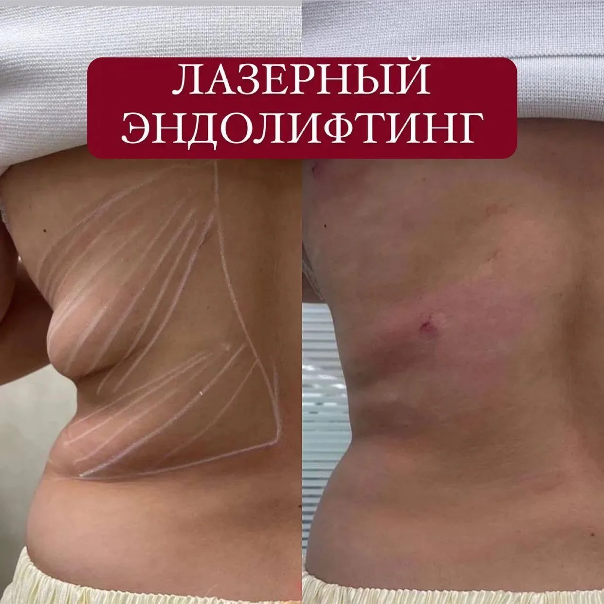 ✨ ВЕРНИТЕ ЧЁТКИЙ ОВАЛ И УПРУГОСТЬ КОЖИ БЕЗ ОПЕРАЦИИ! ✨