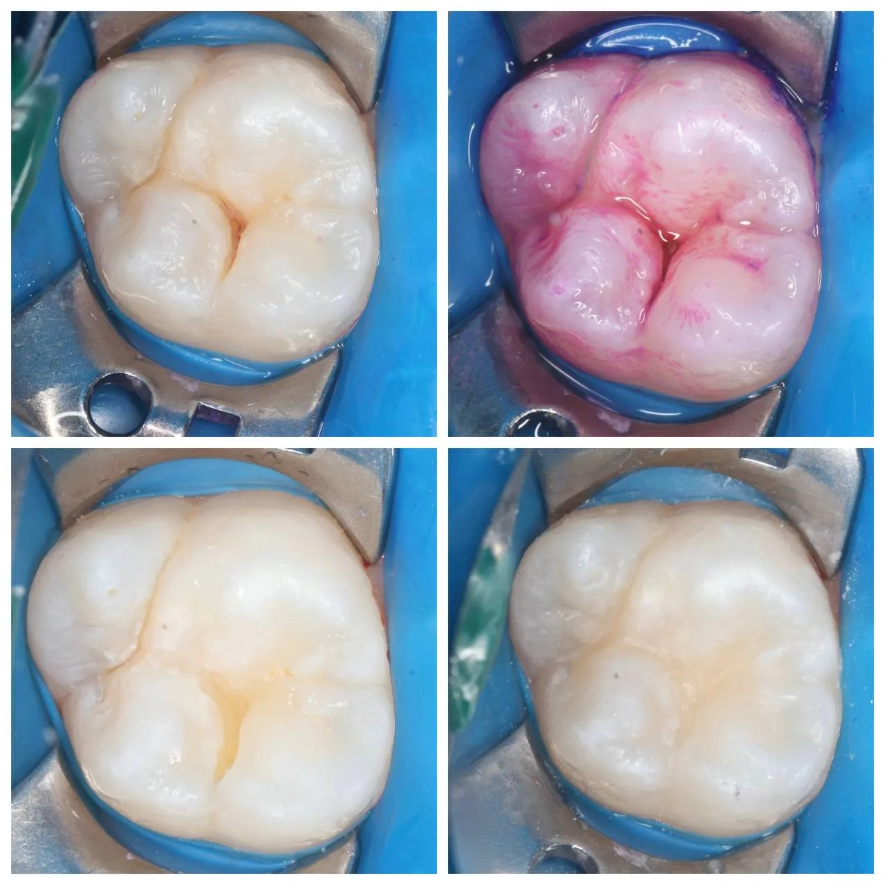 Я сейчас в пути на конференцию 🦷 и пока еду - хочу вам показать один интересный клинич...