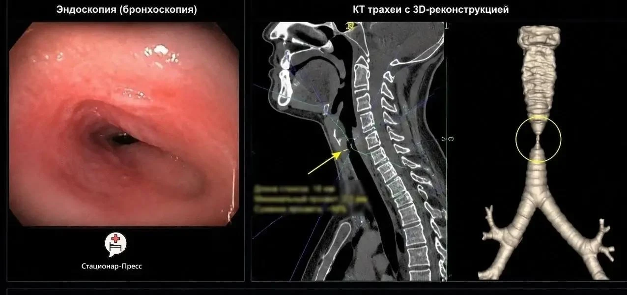 🙏 Уникальную операцию провели нижегородские врачи для спасения пациента с сужением трахеи