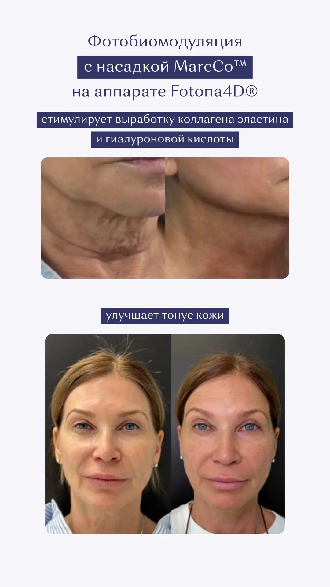 ФОТОНА 4D – НОВАЯ ТЕХНОЛОГИЯ В ПОСОЛЬСТВЕ КРАСОТЫ 👏