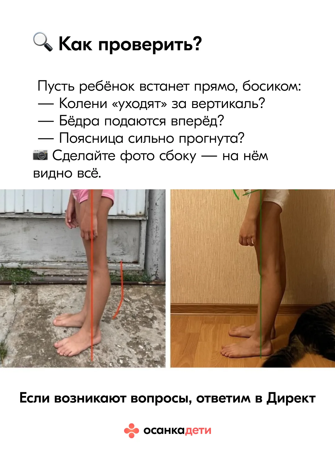 Колени-бананы 🍌 Насколько это опасно?  Переразогнутые колени у детей выглядят безобидно, и даже сейч