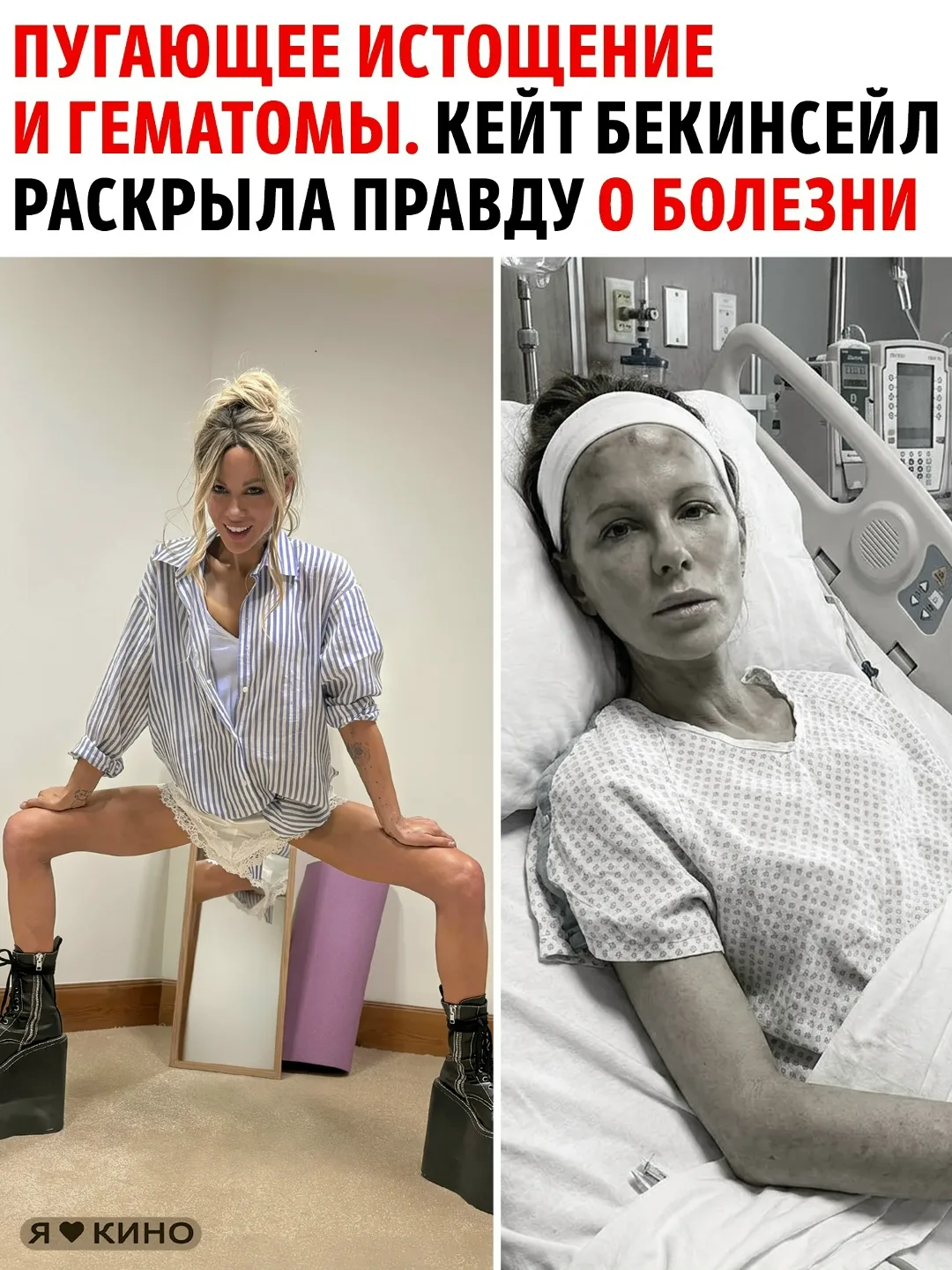 От голливудской красавицы до жизни под капельницами: Кейт Бекинсейл шокировала признани...