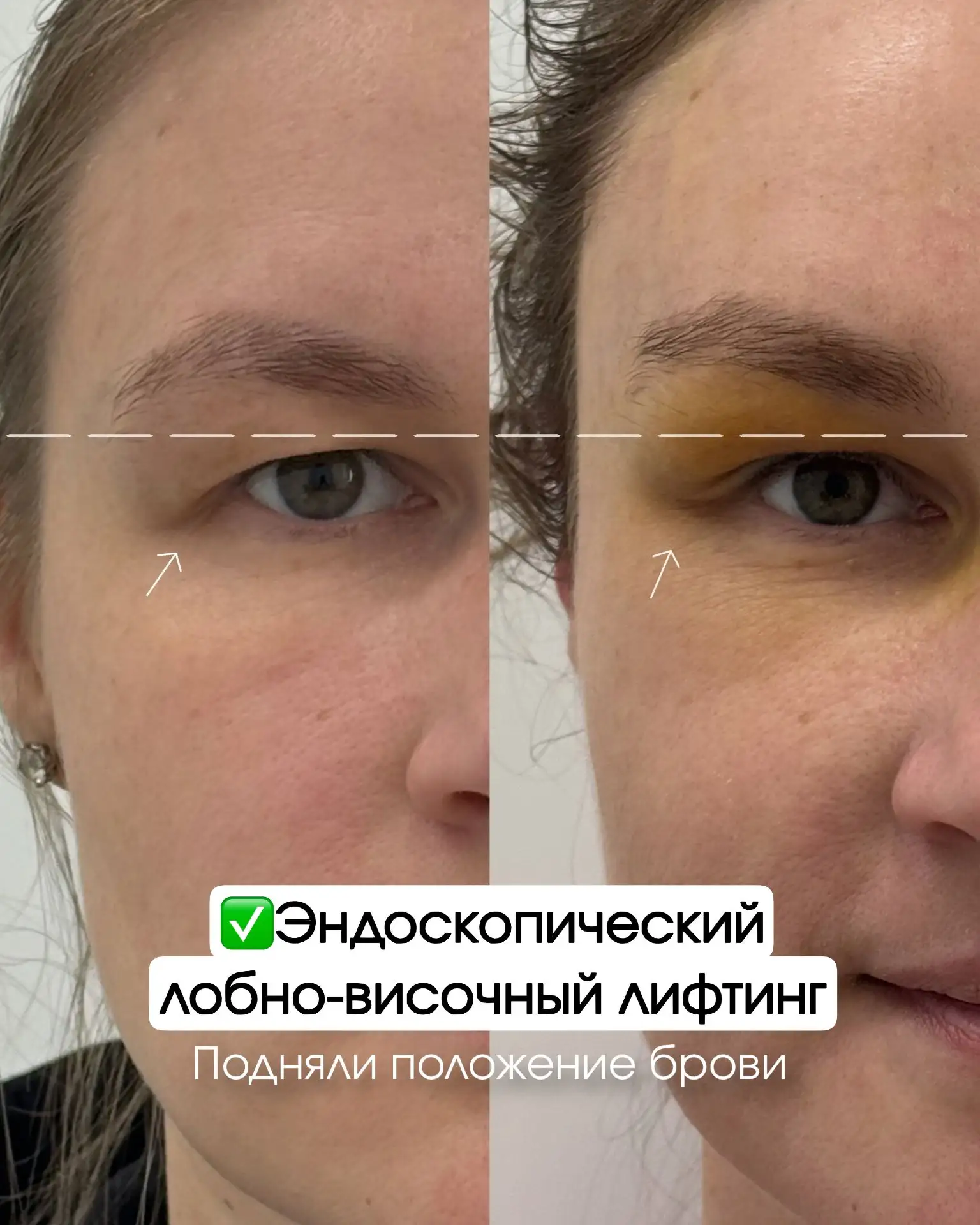 Избавились от тяжелого взгляда за одну операцию😍🤩На фото ранний результат, всего 5 сутки после опе