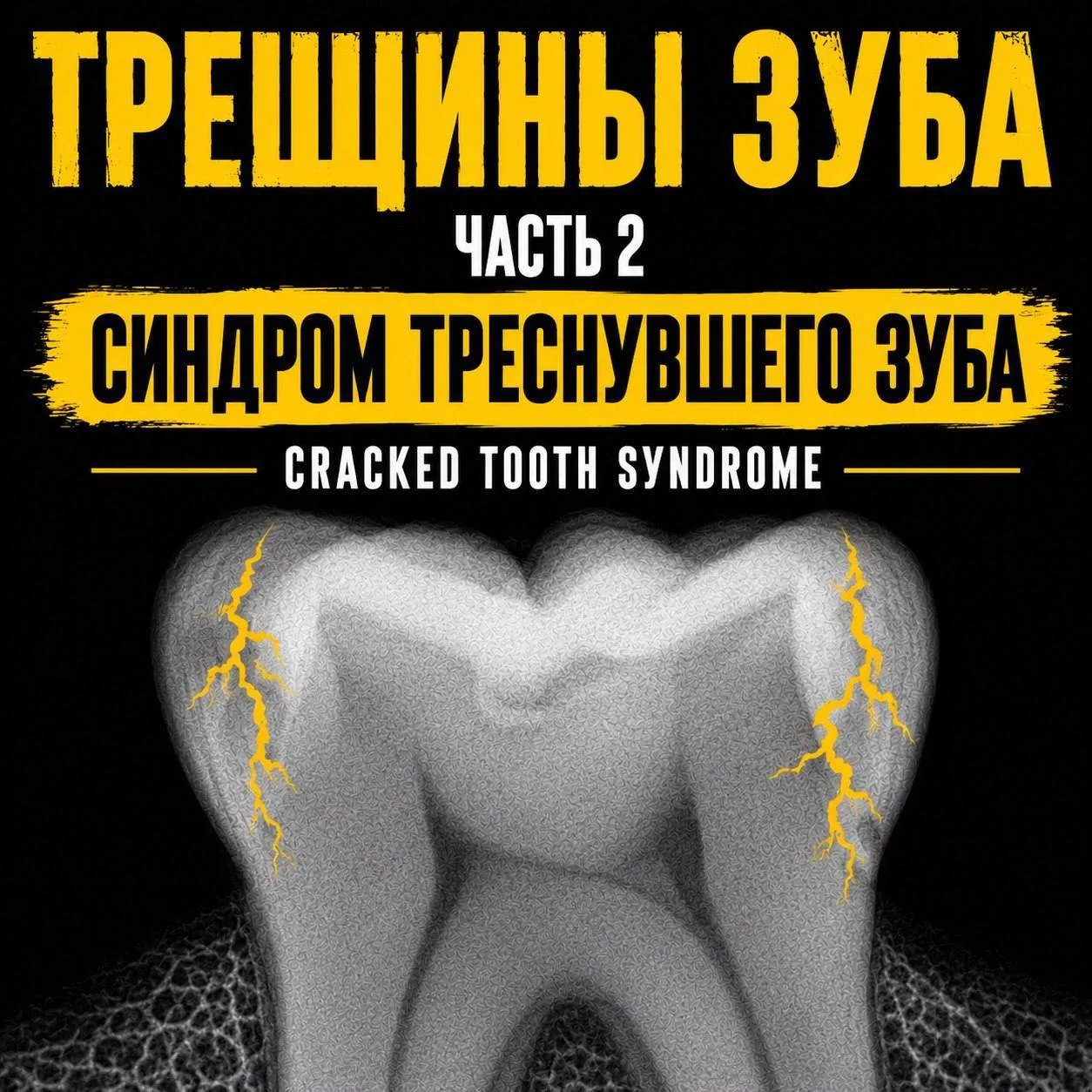 ❗️Классификация синдрома треснувшего зуба

I - Трещина ограничена эмалью.

II - Трещина распространя