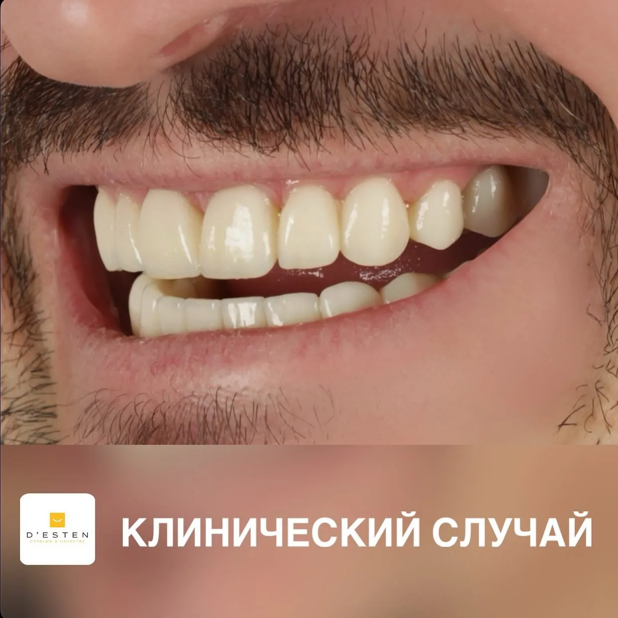 Омоложение с помощью новой улыбки. Рассказываю👇