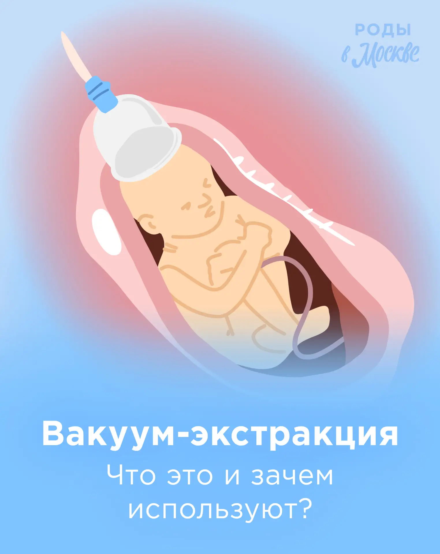 😱 Вытаскивают ребека за голову?! Так ли опасна вакуум-экстракция? 

Многие будущие мамы пугаются, у