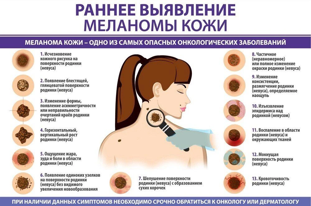 🏥Внимание: меланома. Как заподозрить?
Родинки — это обычные пигментные кожные образования. Они могу